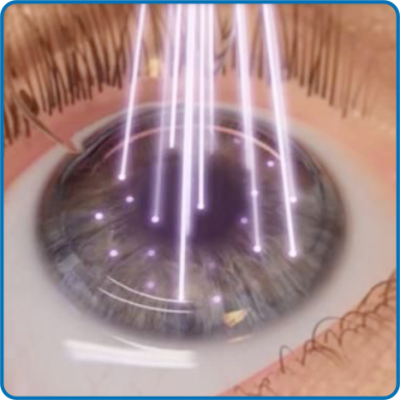 FEMTOCONTOURA, la técnica que está revolucionando el Lasik