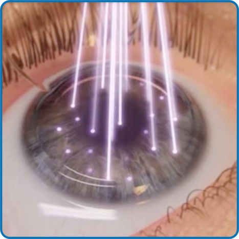FEMTOCONTOURA, la técnica que está revolucionando el Lasik