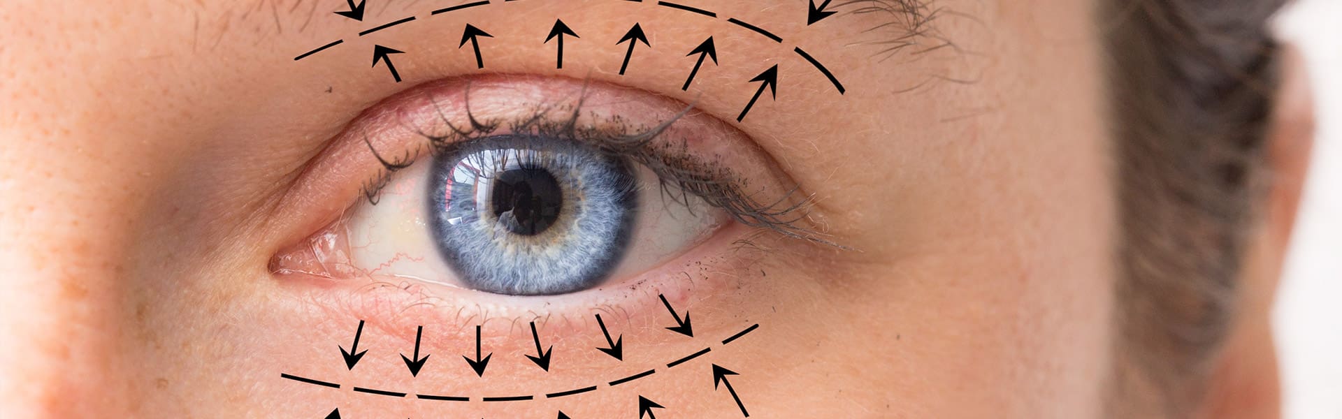 Blefaroplastia - Cirugía Estética de Párpados - Fundonal