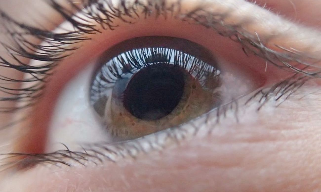 queratocono-enfermedad-progresiva-de-la-cornea