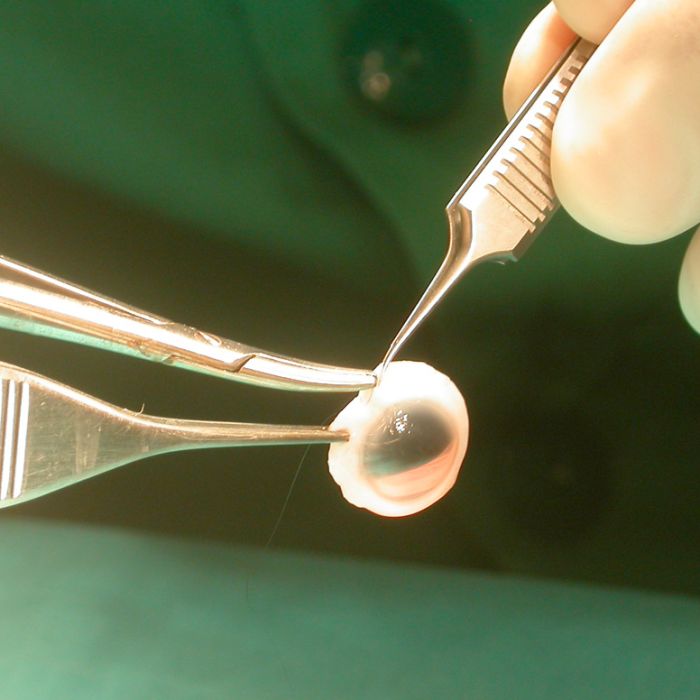 Un trasplante que cambió su vida